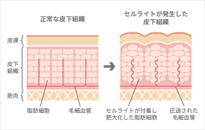 Why?どうして“セルライト”がついてしまうの?のイメージ